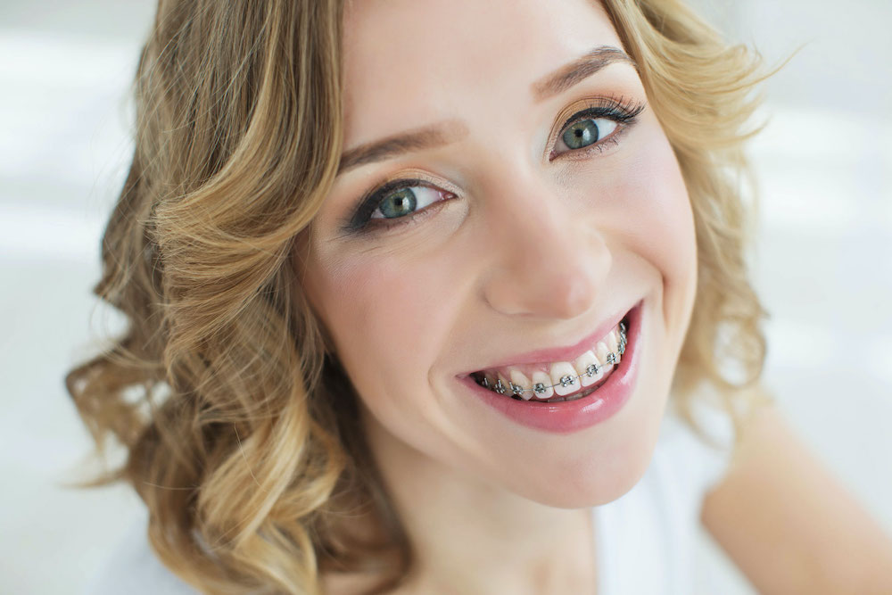 Learn how orthodontic insurance can help you pay for Invisalign or braces in Charleston SC