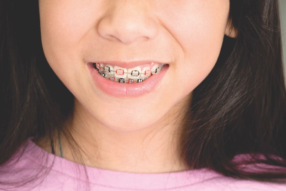 Learn how kids and teens can personalize their braces in Charleston SC