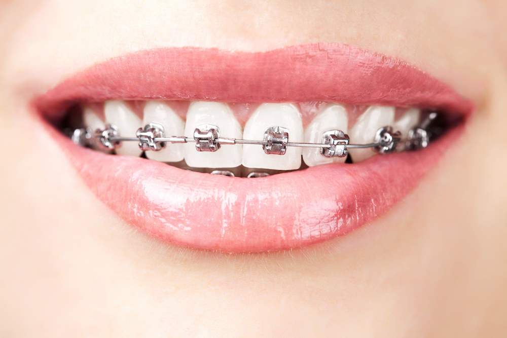 Our braces in Charleston SC use space age wire to move teeth