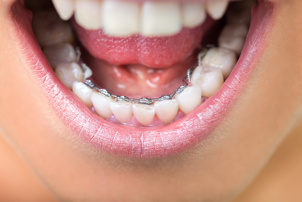 Close up of lingual braces A Charleston orthodontist discusses braces that go behind the teeth
