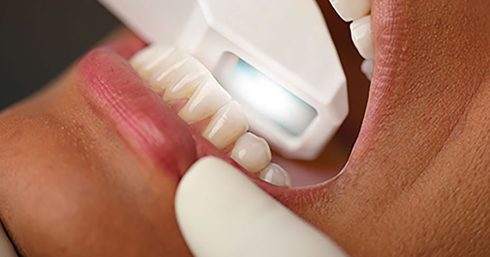 Digital scanner for teeth molds
