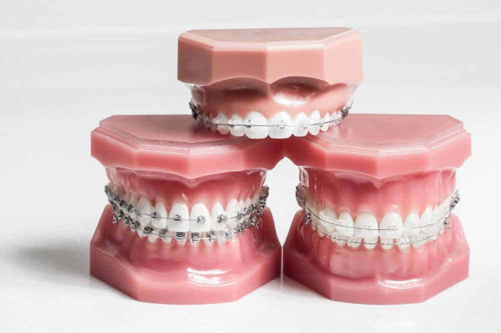 What are bite classes? understanding bite classes orthodontist goose creek south carolina