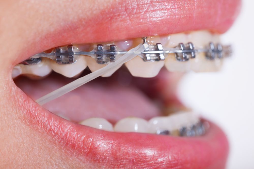 Rubber bands for Braces