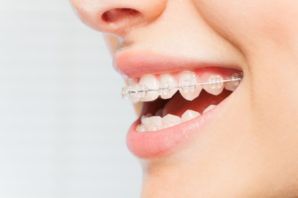 Wonderful Ceramic Braces Wonderful Ceramic Braces