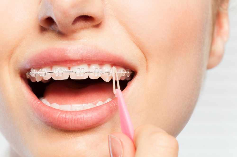 different parts of braces and what they do orthodontist st george south carolina