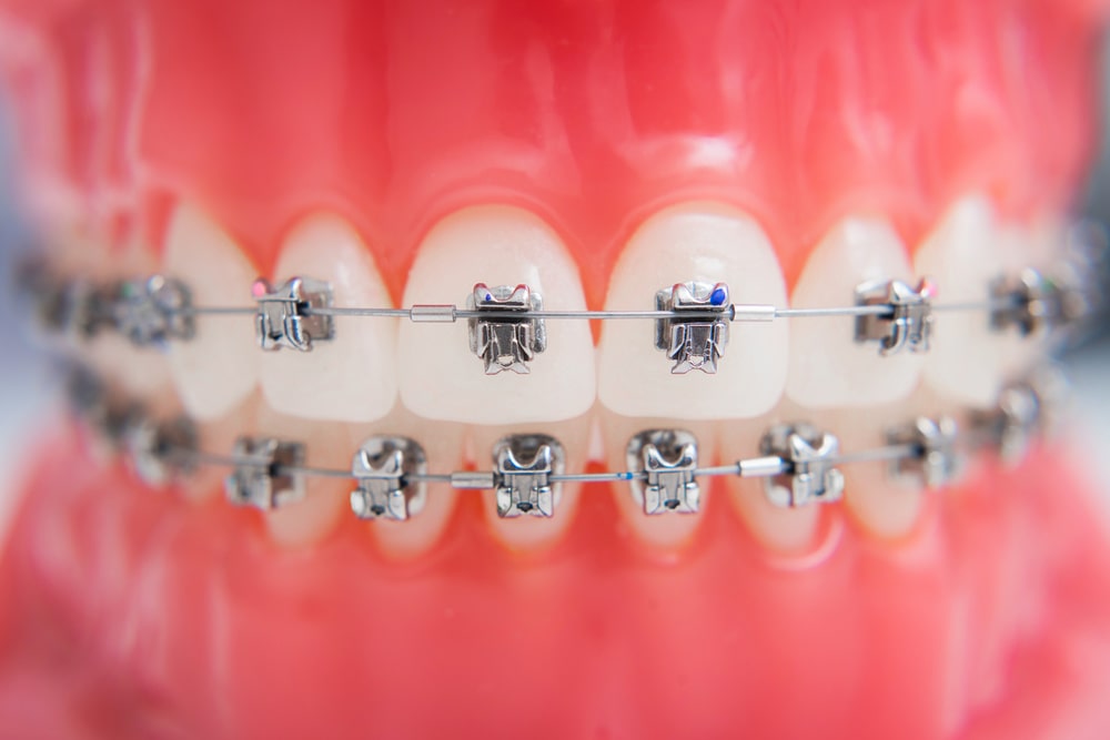 avoiding-gum-disease-with-braces