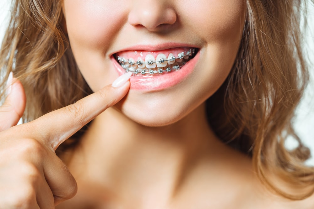 Learn why you should get braces in Charleston SC