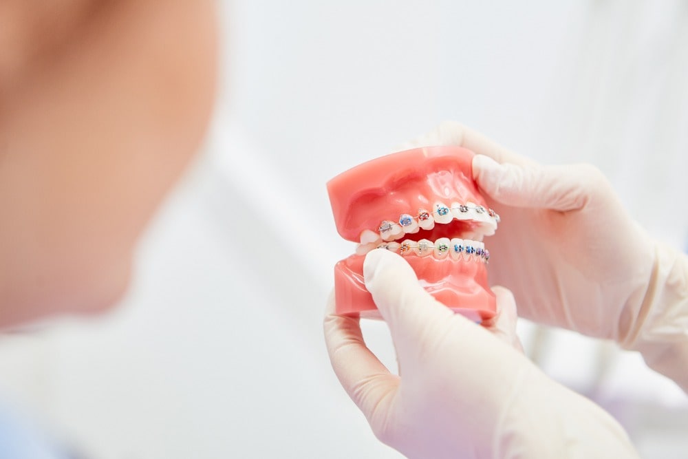 Braces may be needed before getting a dental implant