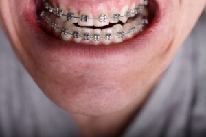 Preventing tooth decay while you have braces can be a breeze.