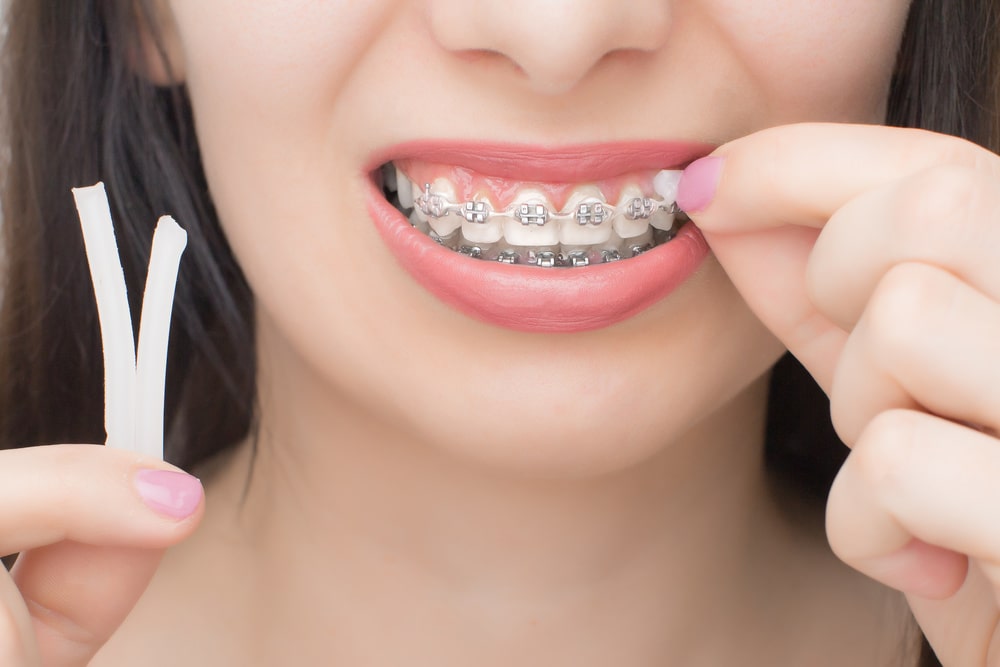 what-is-orthodontic-wax