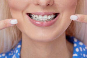 Keep teeth stain-free with braces in Charleston SC