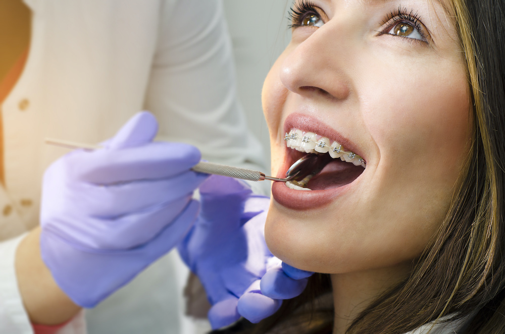 Closeup of beautiful girl on dental braces check up Here are five things you won't hear an orthodontist in Mt Pleasant say