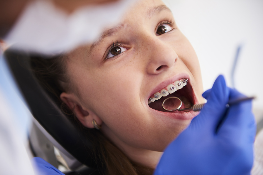 Girl with braces during a routine, dental examination Learn how getting braces in Charleston SC can help prevent cracked teeth